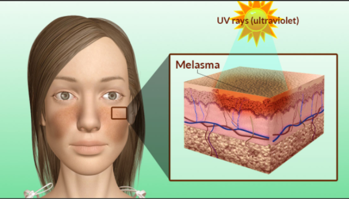 melasma emulsion